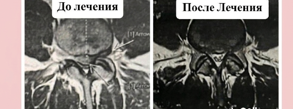 MRT: axial sections before and after the treatment course