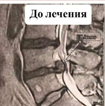 МРТ до лечения