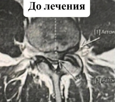 МРТ до лечения